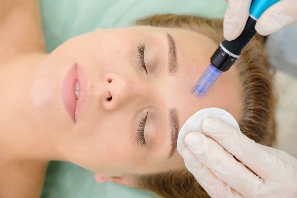 Microneedling