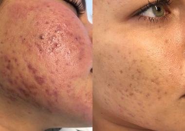 Microneedling