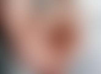 Why Do People Get Kidney Stones in the Summer?