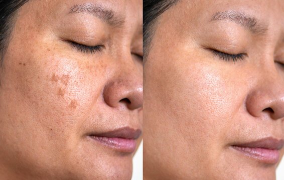 Before After Skin